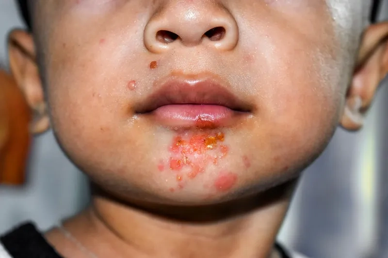 An overview of what causes impetigo to develop