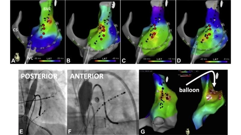 Inappropriate Sinus Tachycardia Treatment helps control rhythm
