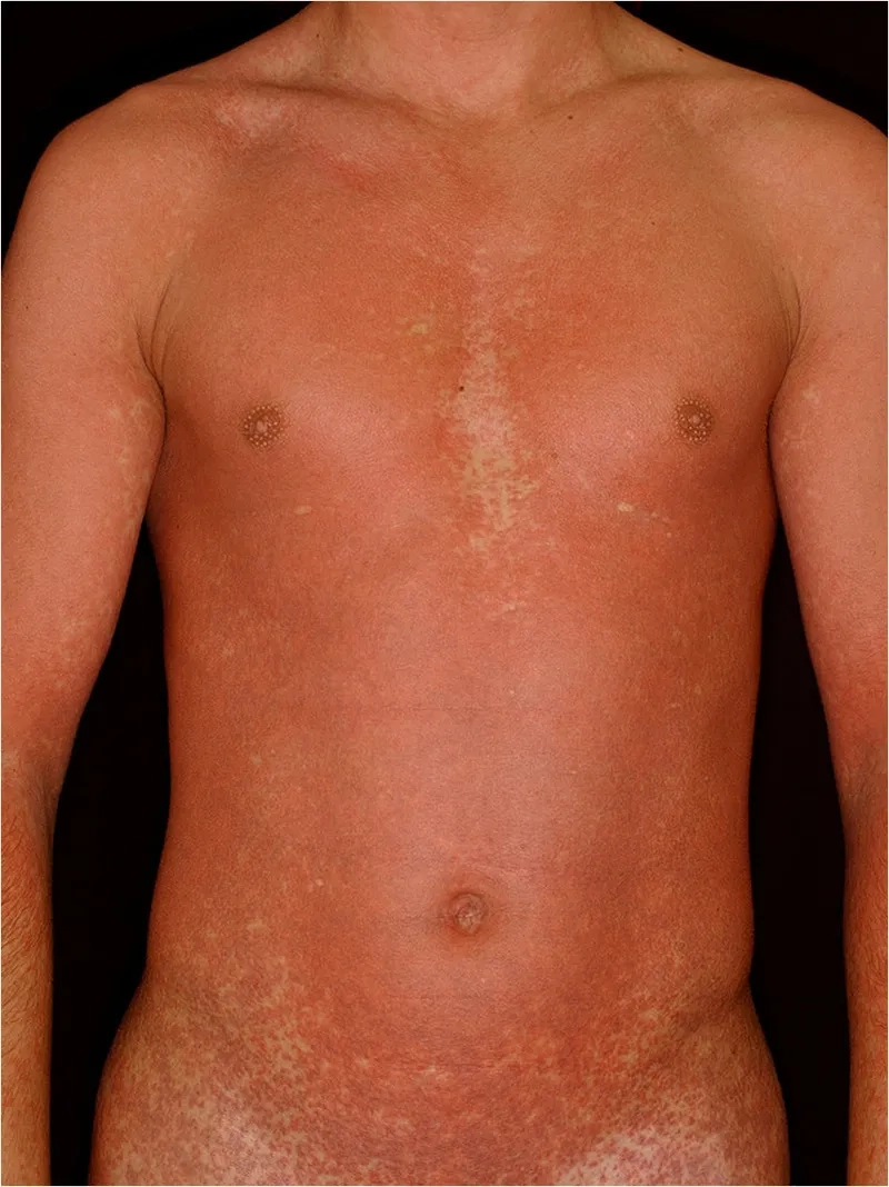 Clinical Mono Rash Pictures for Identification