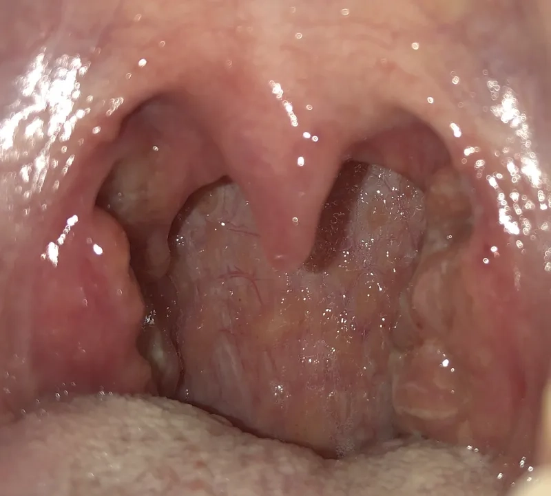 What is the Kissing Disease: An Explanation