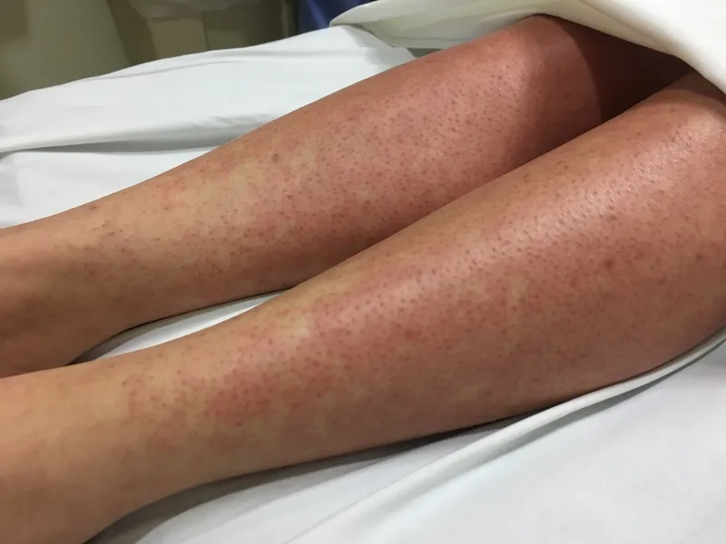 Comparing a Mono Sore Throat vs Strep Infection