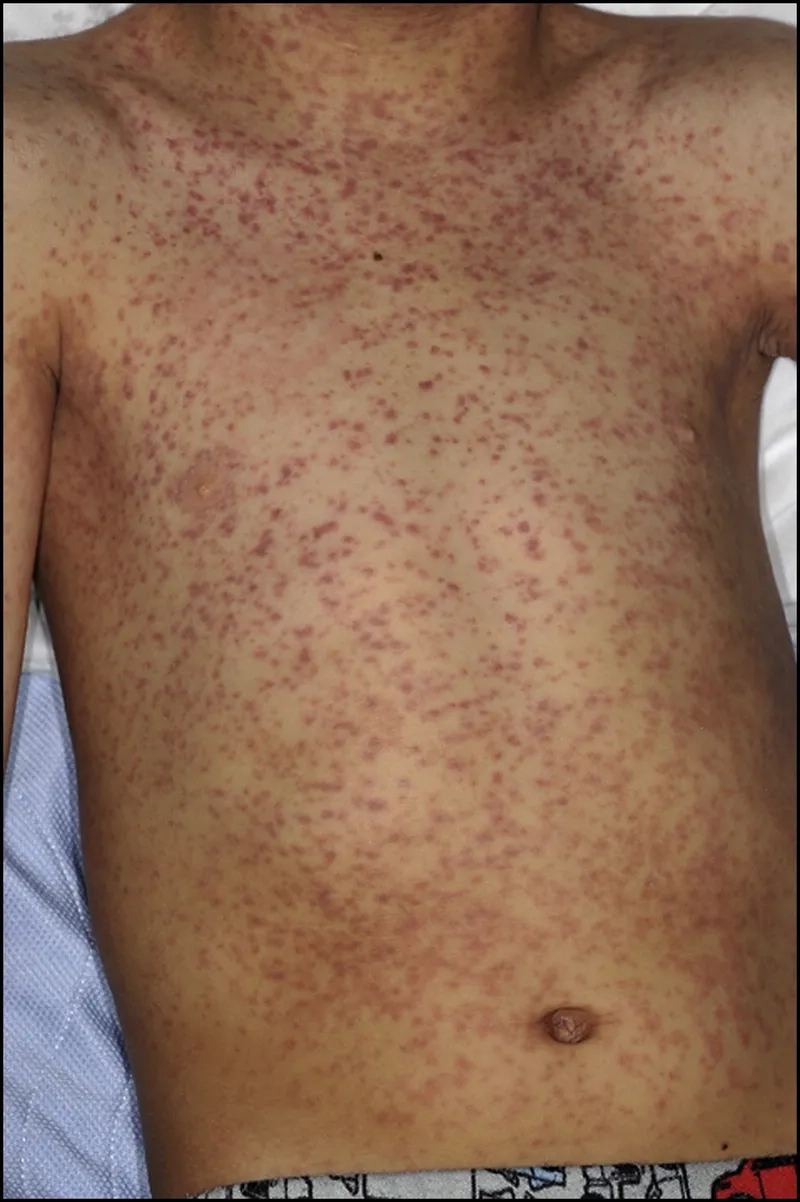 Exploring Mono Treatment for Adults and Recovery