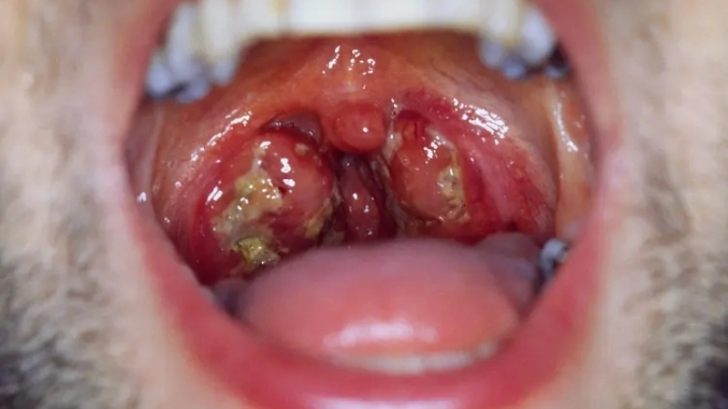 Infectious Mononucleosis how mononucleosis contagious spreads