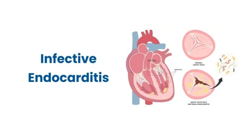 Infective endocarditis symptoms warning signs of valve infection