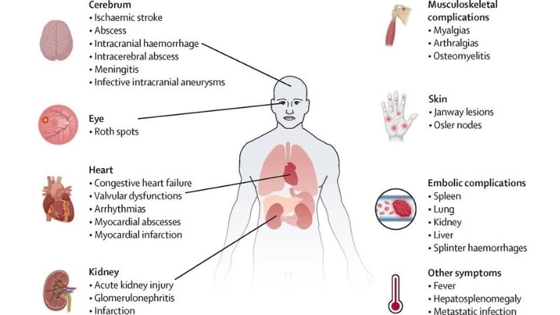 Causes of infective endocarditis underlying triggers of infection
