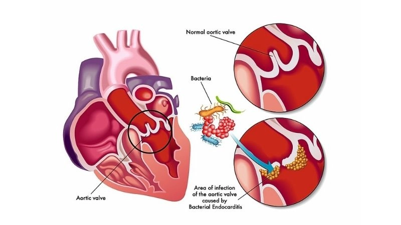 Infective endocarditis and prosthetic valves risks with implants