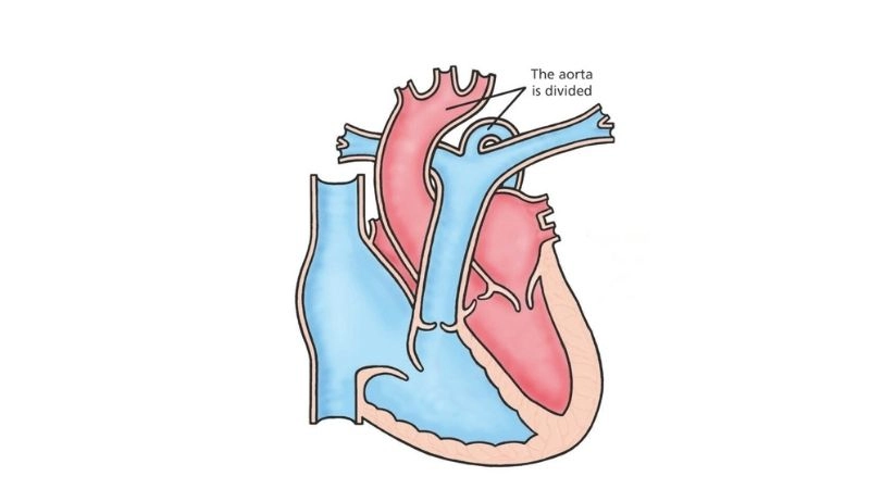 Interrupted aortic arch symptoms recognition and signs