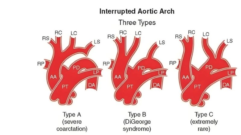 Interrupted aortic arch in adults rare presentation