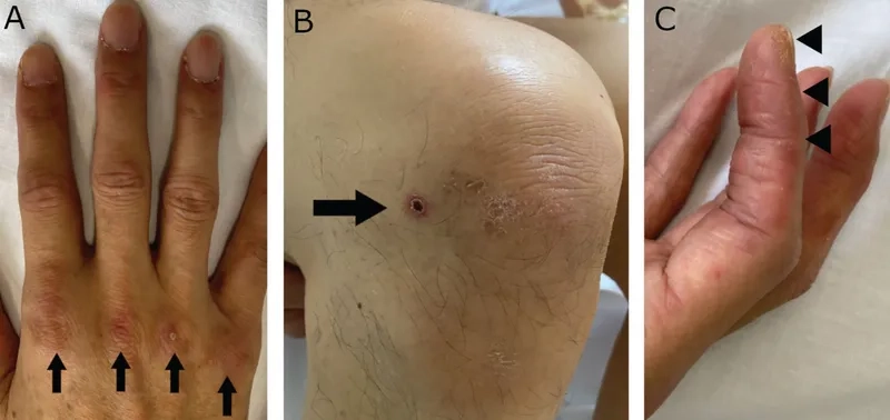 A lung CT scan of idiopathic pulmonary fibrosis (IPF)
