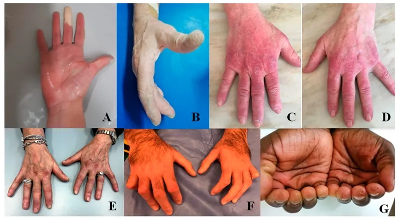 A chart showing the general ILD prognosis for patients