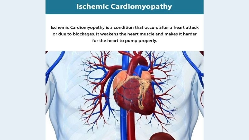 Ischemic cardiomyopathy symptoms include chest pain and fatigue