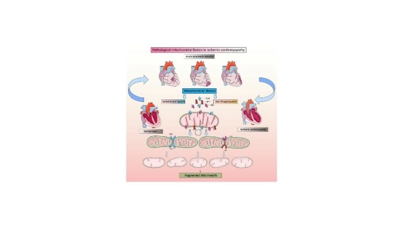 Ischemic heart disease is the root of cardiomyopathy