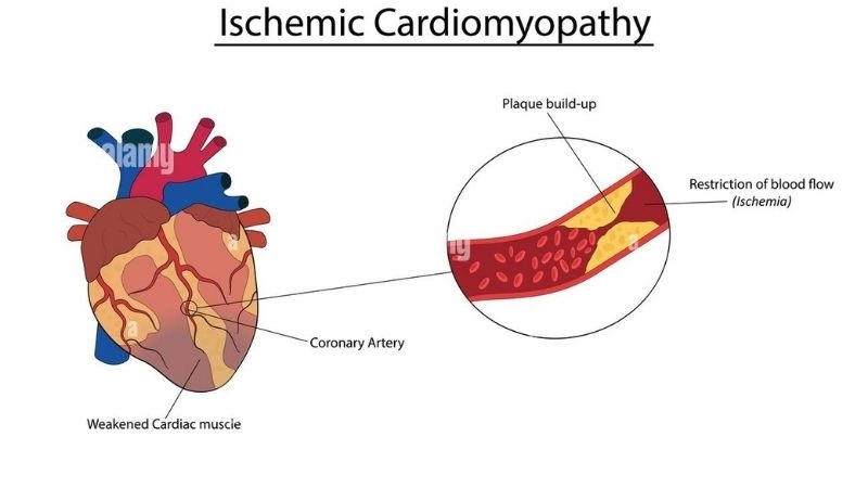 Coronary artery disease leads to ischemic cardiomyopathy