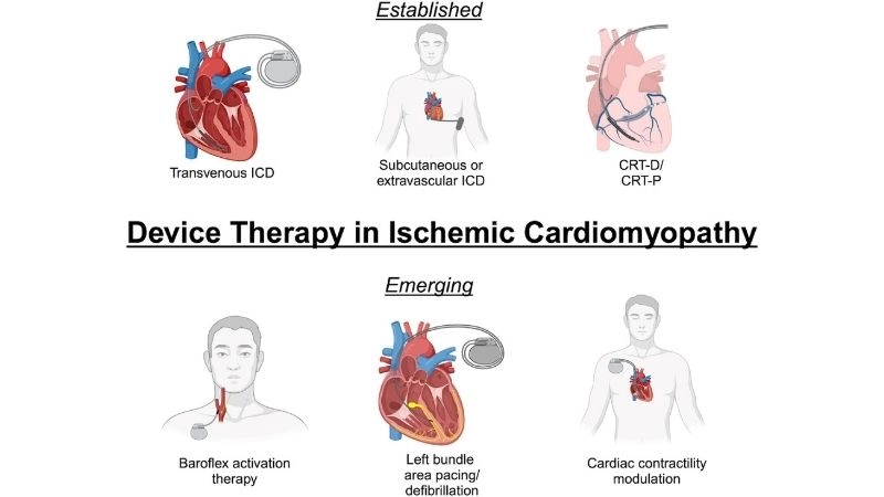 Heart failure is common with ischemic cardiomyopathy