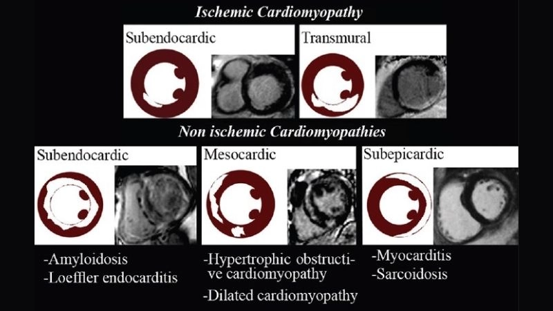 Ischemic cardiomyopathy prognosis depends on severity