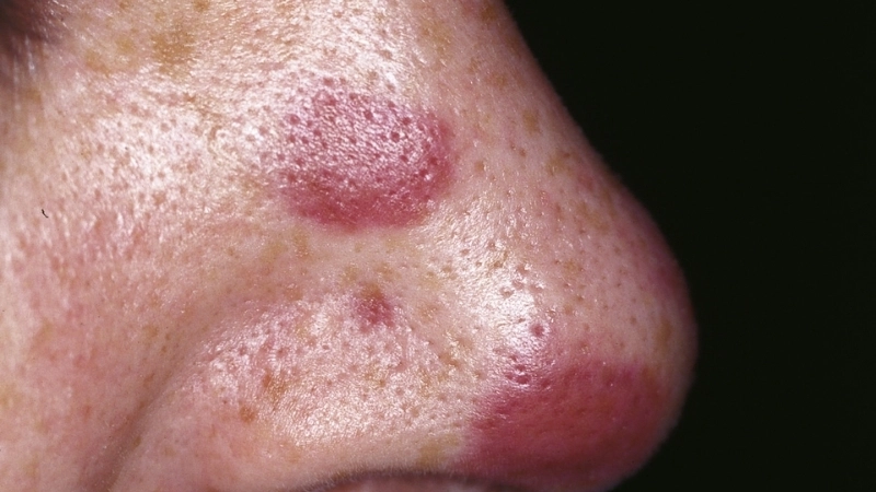 Kaposi's Sarcoma linked to HHV-8