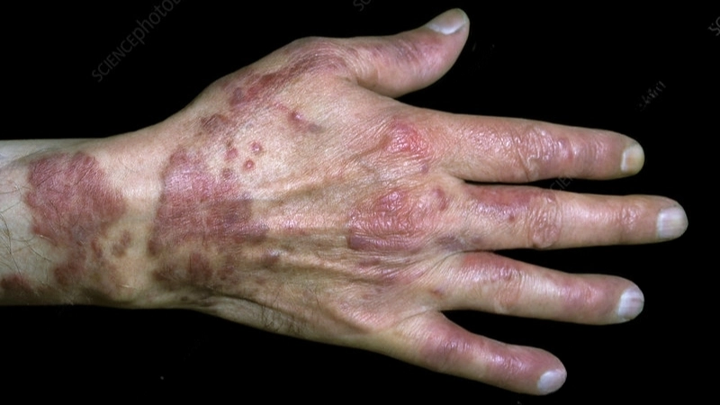 Kaposi's Sarcoma needs treatment