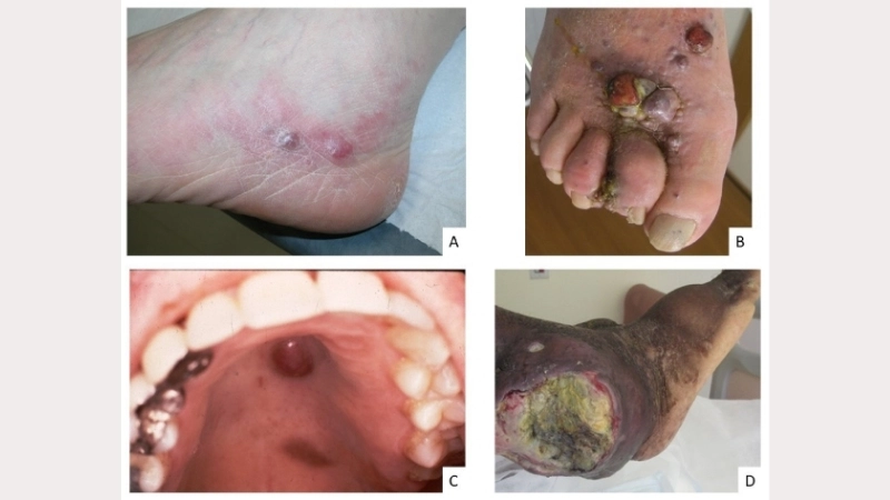 Kaposi's Sarcoma is angioproliferative