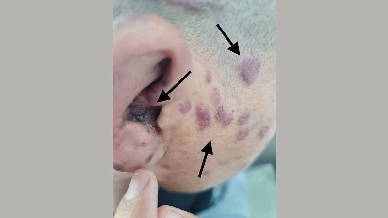 Kaposi's Sarcoma as AIDS defining