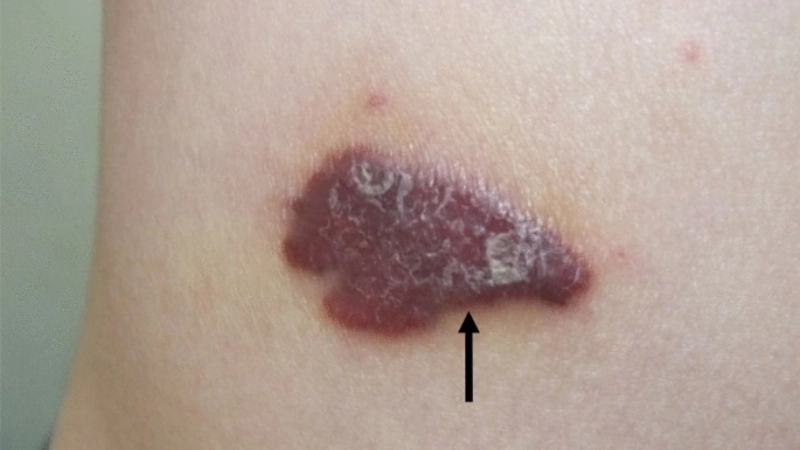 Kaposi's Sarcoma linked with HIV