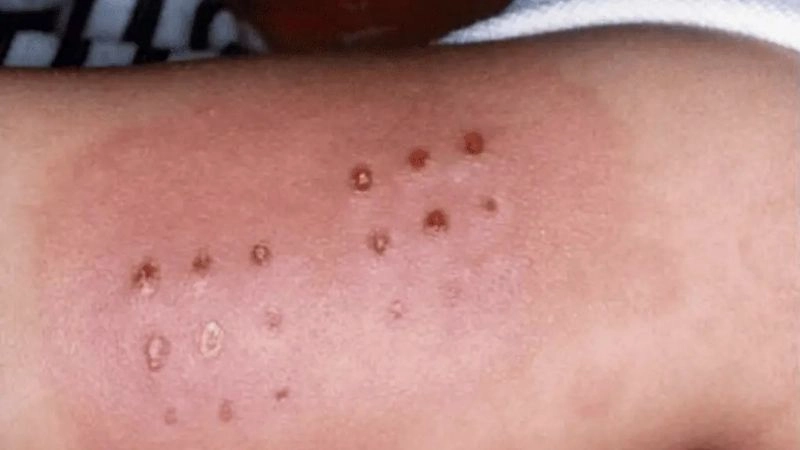 Kawasaki disease in adults and rare occurrences