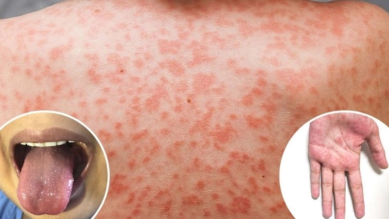 Is Kawasaki disease contagious or infectious