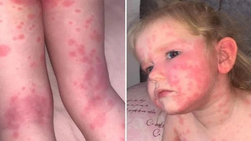 Kawasaki disease strawberry tongue as a key symptom