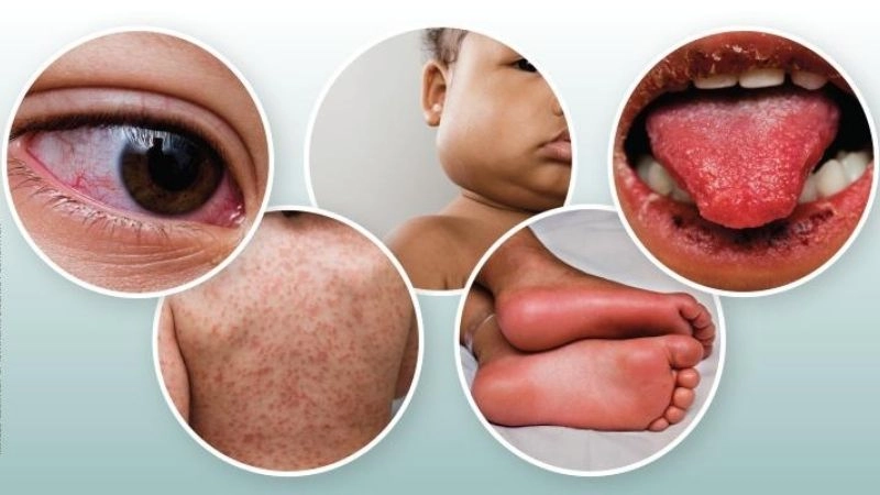 Kawasaki disease vs scarlet fever major differences