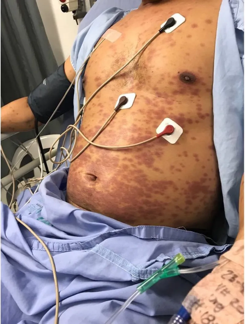 Diagnosing rare cases of Kawasaki disease in adults