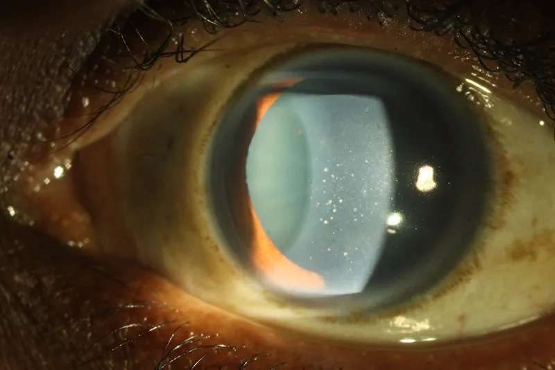 Diagram illustrating the different types of keratitis