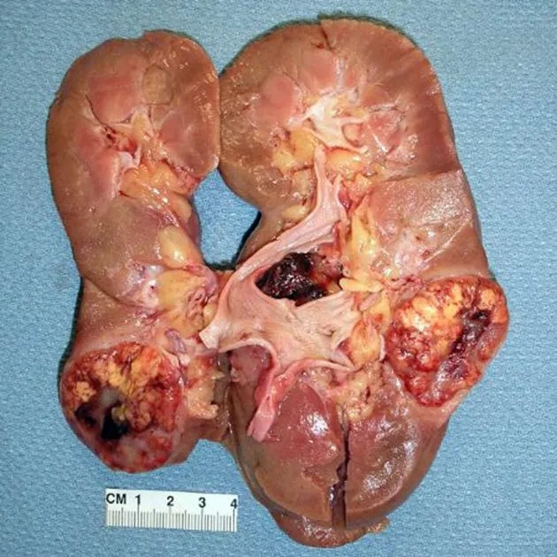 Understanding Renal Cell Carcinoma