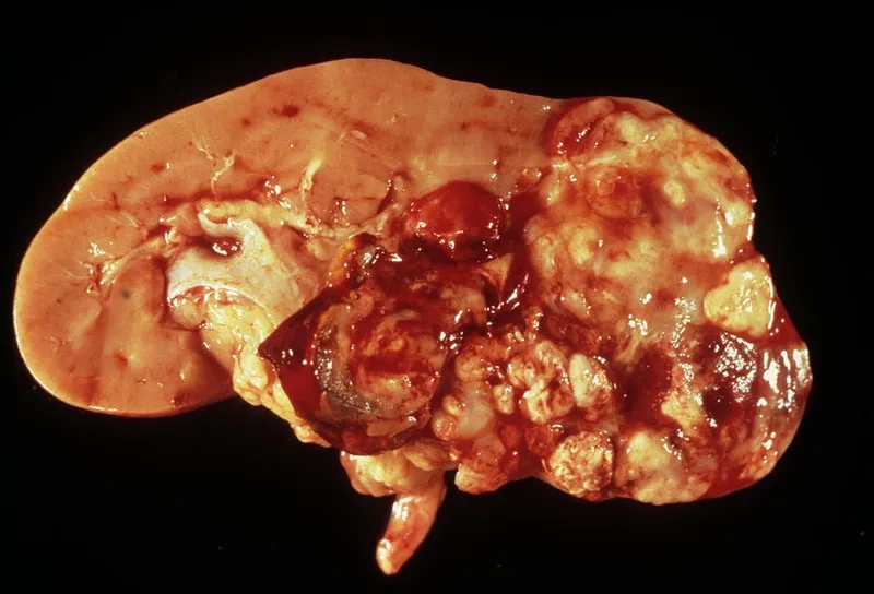 The Different Stages of Kidney Cancer
