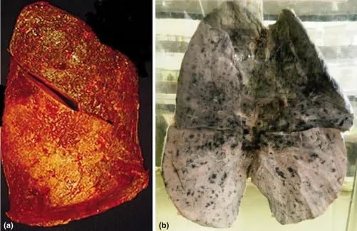 An overview of effective Kingella kingae treatment