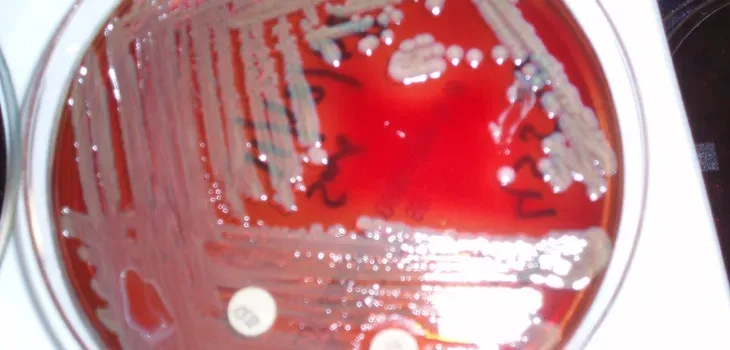 Osteomyelitis as a result of Kingella kingae