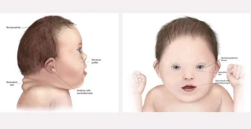 Klinefelter syndrome karyotype and chromosomal findings