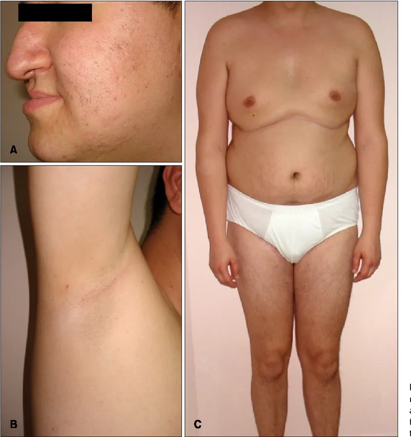Mosaic klinefelter syndrome and clinical variations