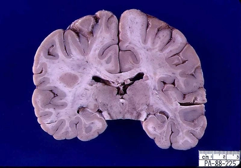 Aedes triseriatus, the La Crosse encephalitis mosquito
