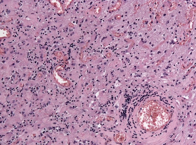 Geographic La Crosse encephalitis cases map