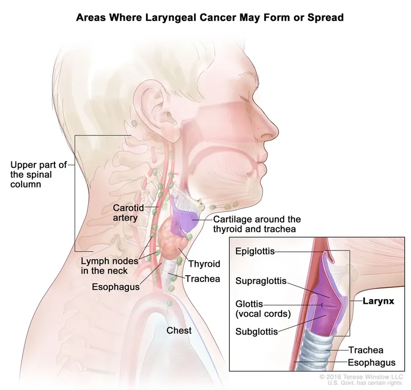 Recognizing laryngeal cancer symptoms for early diagnosis