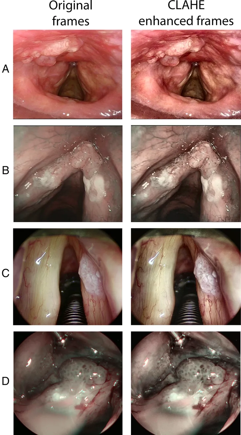 Hoarse voice cancer warning signs and awareness