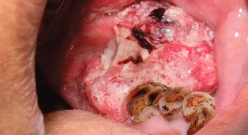 Advanced laryngeal cancer treatment options