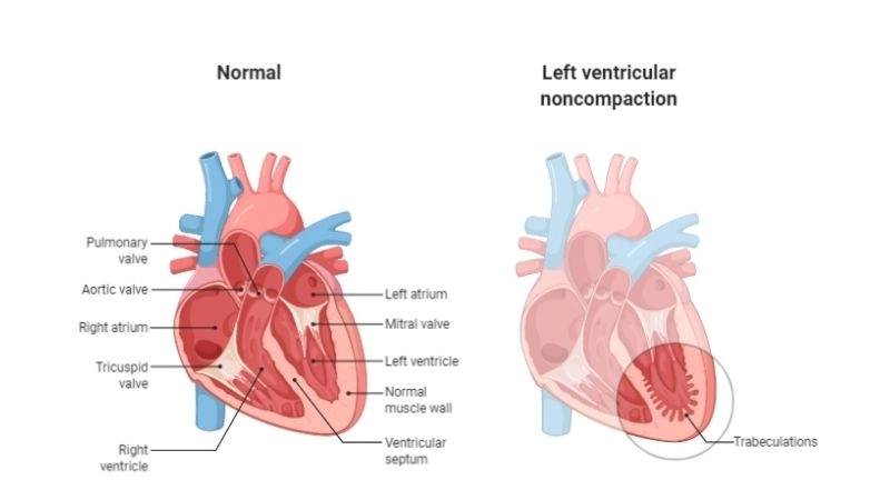 Left Ventricular Non-Compaction Cardiomyopathy diagnosis confirmed with echo and MRI