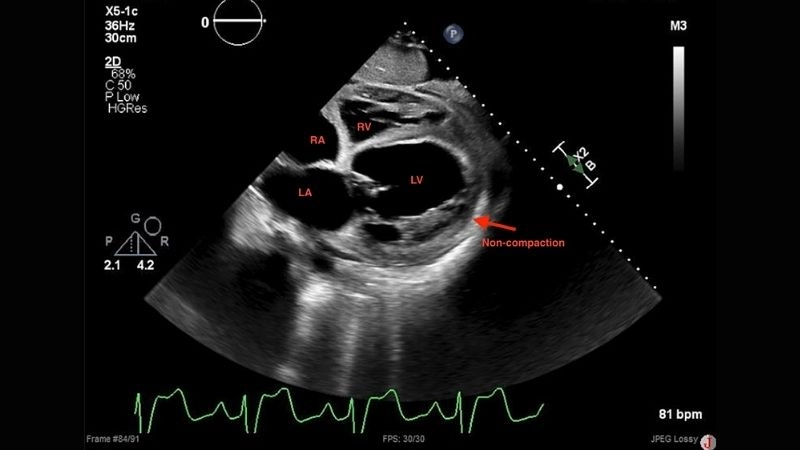 Left Ventricular Non-Compaction in children may lead to heart failure