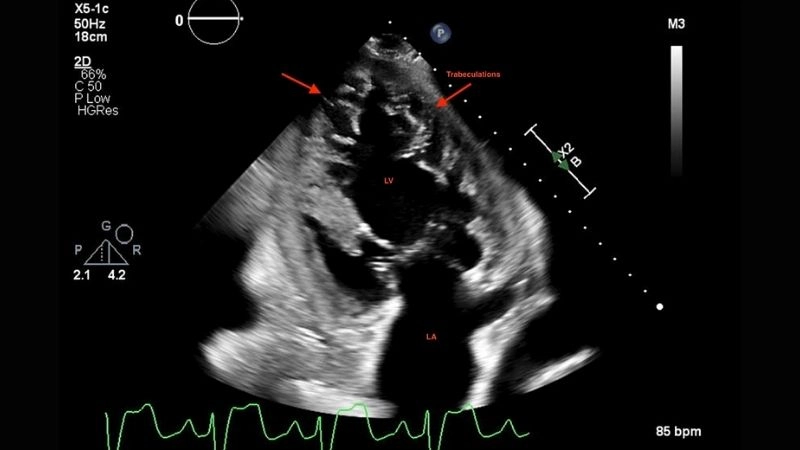 Spongy myocardium heart condition also means Left Ventricular Non-Compaction