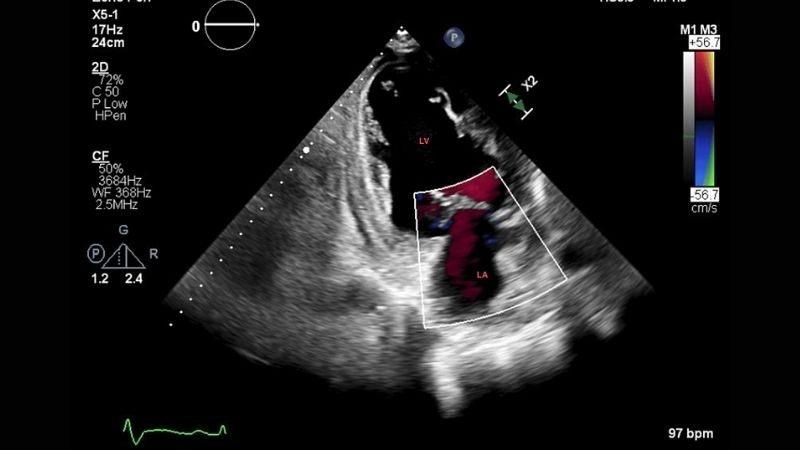 Left Ventricular Non-Compaction genetic testing guides family screening