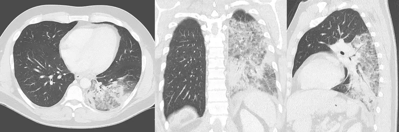 Chest X-ray showing Legionellosis pneumonia