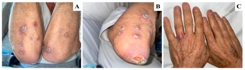 A clinical example from Leishmaniasis rash pictures