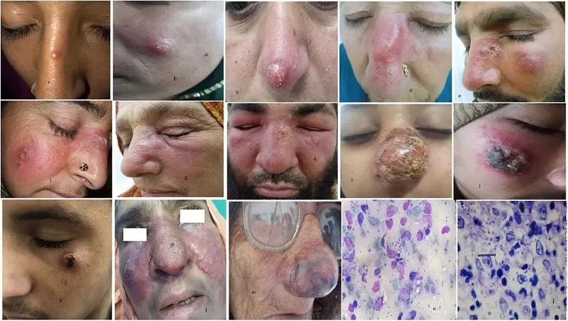 A skin biopsy sample used for Leishmaniasis diagnosis