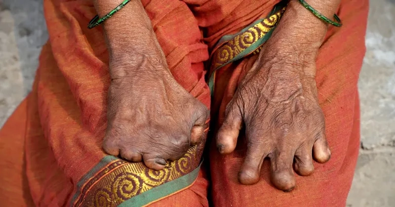 Leprosy treatment medication options available