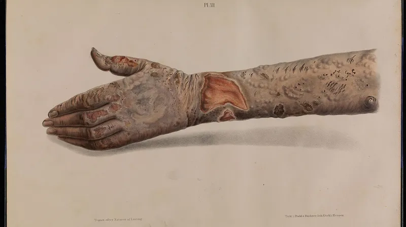 Observing World Leprosy Day to raise awareness